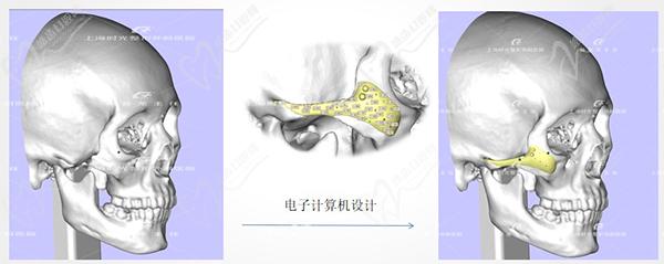 何晋龙医生下颌角磨骨价格