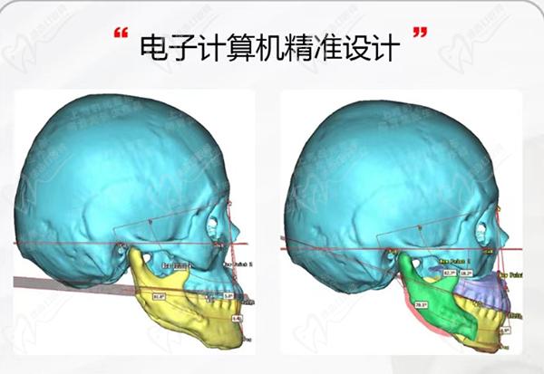 何晋龙磨骨失败 率高吗