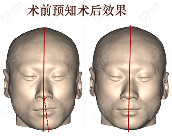 何晋龙正颌真人案 例分享