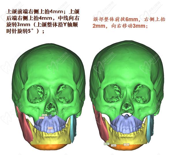 何晋龙正颌真人案 例分享