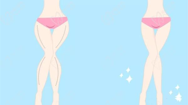 吸脂