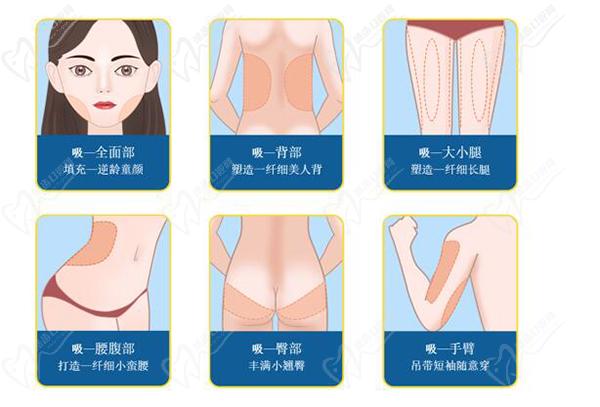 吸脂