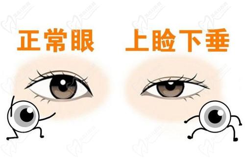 北京美和眼科医院于刚医生做上睑下垂矫正的技术娴熟