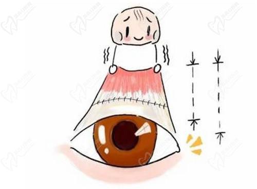 北京美和眼科医院于刚医生做上睑下垂技术成熟