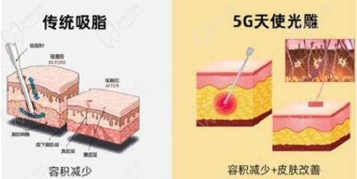 王曾思做吸脂手术怎么样？