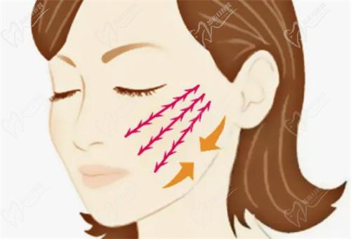 李高峰医生拉皮也很擅长