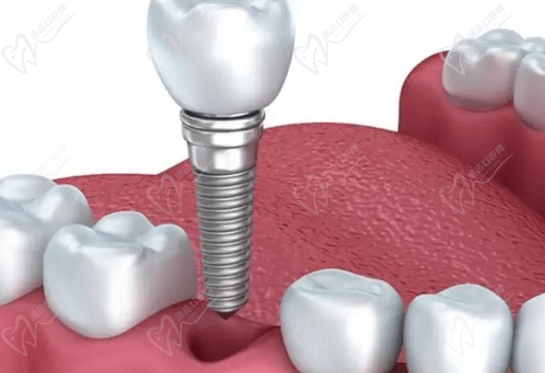 美国皓圣种植牙有什么优势