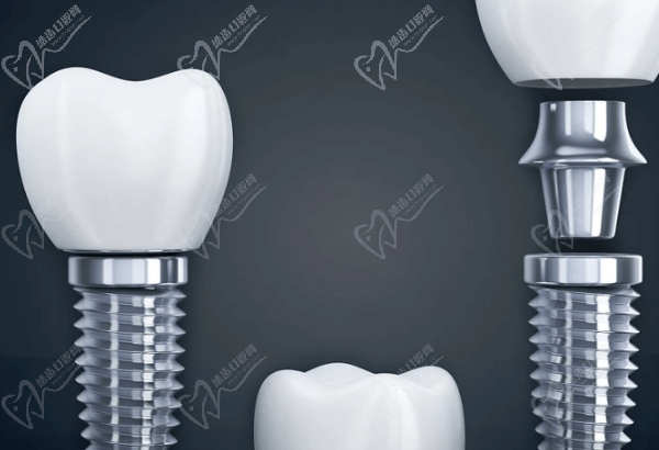 美国皓圣种植牙好不好