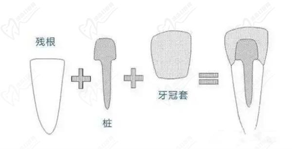 牙齿打桩