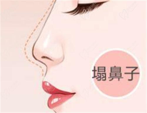 郑州东方整形美容医院隆鼻多少钱？