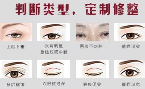 郭建玲双眼皮修复技术怎么样