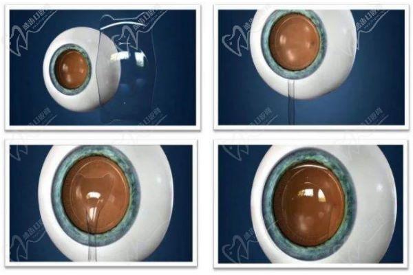 武汉佰视佳眼科晶体植入价格 武汉佰视佳眼科晶体植入价格