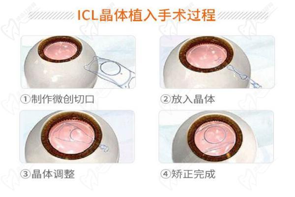 ICL晶体植入手术过程