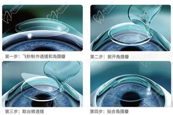 ICL晶体手术步骤