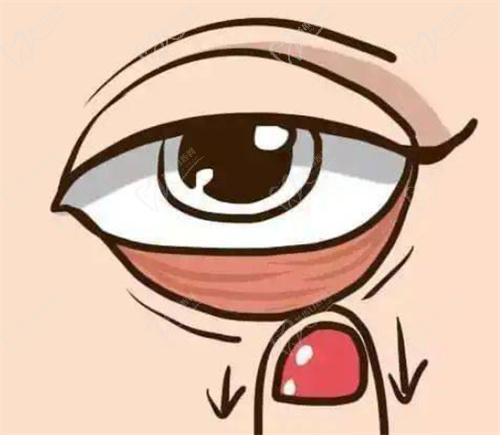 王志医生做下睑修复手术有什么优势？