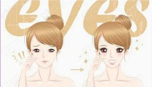 上海杨亚益双眼皮