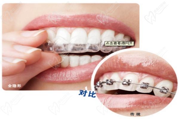 福州维乐口腔隐适美全隐形矫正优点