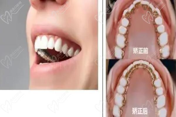 福州维乐口腔隐适美全隐形矫正阶段