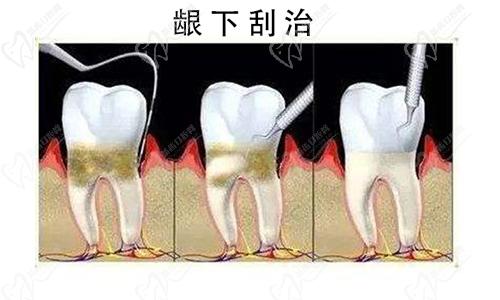 宜昌中汉口腔医院做龈下刮治全过程