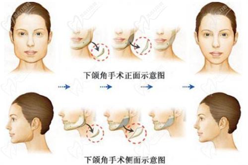 刘先超医生做下颌角磨骨手术怎么样？