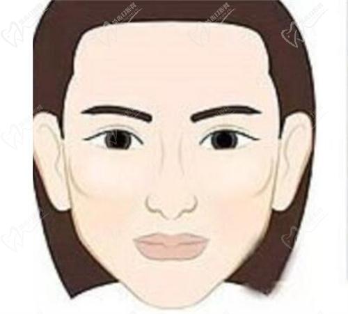 刘先超做颧骨内推怎么样？
