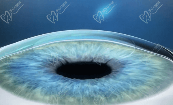 深圳博爱曙光医院眼科全飞秒近视手术优势