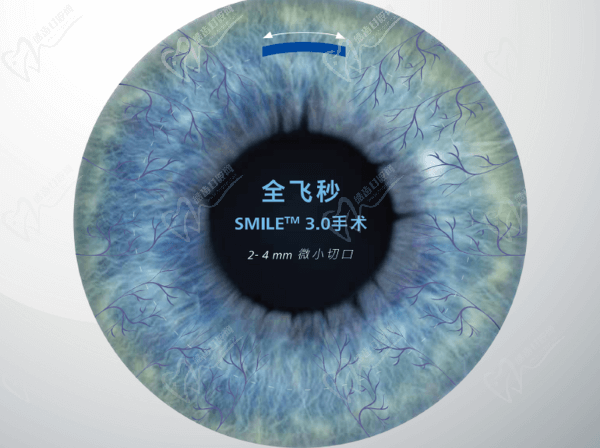 深圳博爱曙光医院眼科全飞秒近视手术技术优势