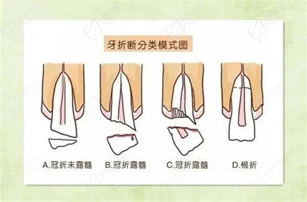 门牙折断