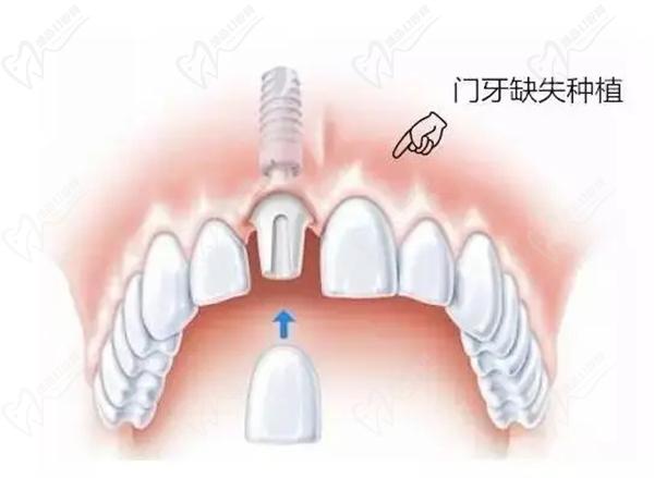 门牙缺失种植