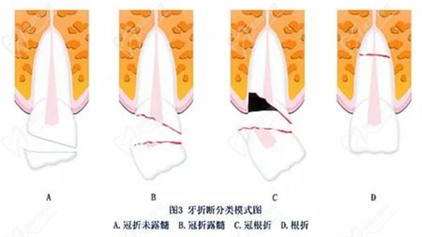 门牙折断