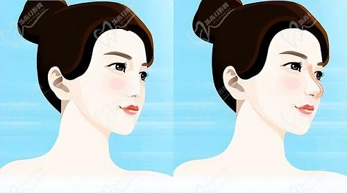 深圳刘冰医院鼻子做得怎么样