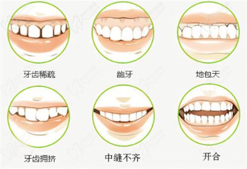 成都新桥口腔时代天使隐形矫正改善牙不齐~