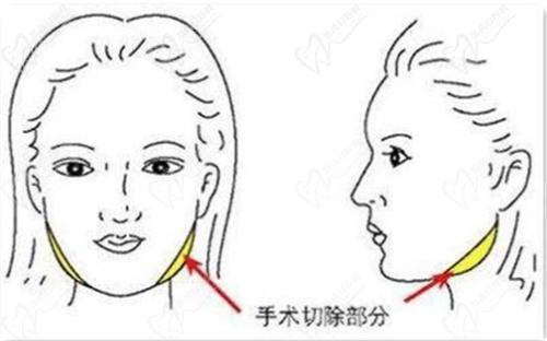 沈阳杏林朱石江医生颌面手术怎么样
