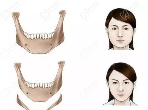 沈阳杏林朱石江医生下颌角整形