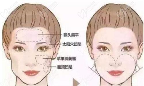 济南韩氏宋世鹏脂肪填充怎么样？