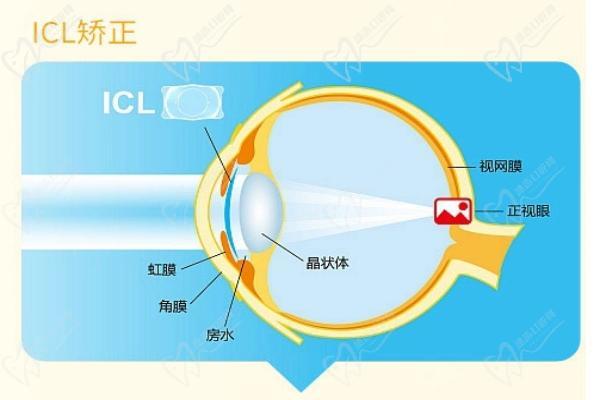 ICL晶体植入矫正