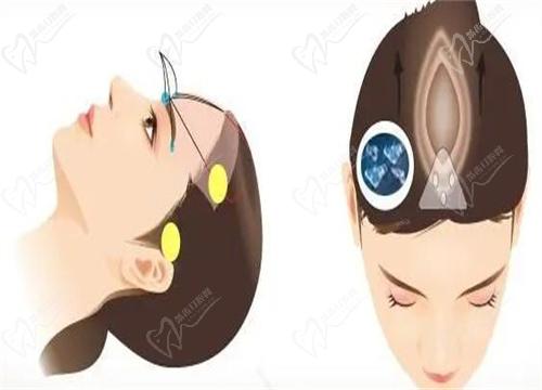 杜太超医生做拉皮手术技术好