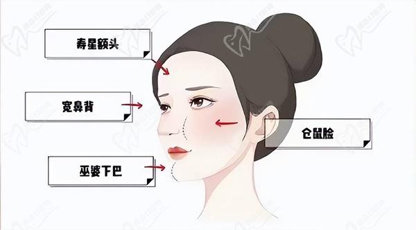 广州注射玻尿酸填充医生推荐