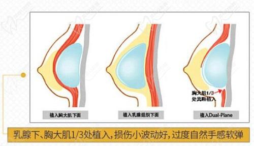 葛海辉院长假体隆胸技术优势