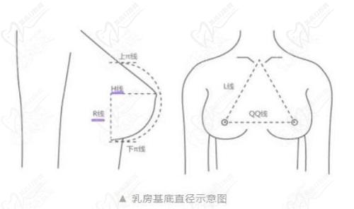 武汉葛海辉做傲诺拉星熠假体丰胸价格7万元起超动感