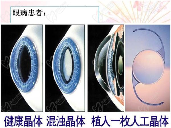 晶体植入