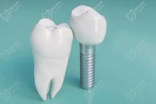 福州维乐口腔韩国奥齿泰种植牙适用人群