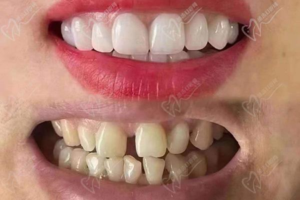 湛江致美口腔医院牙齿贴面怎么样