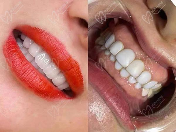 全口超薄牙贴面好不好