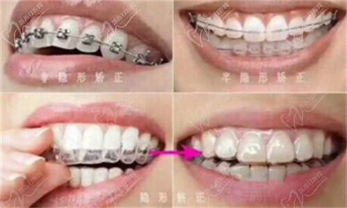 朱峰医生正畸技术好! 朱峰医生正畸技术好!