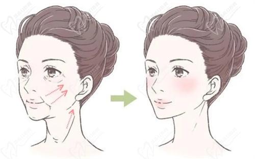 沈阳杏林整形医院拉皮