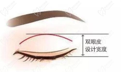 武汉美莱徐平医生的park法眼综合技术有什么特色？