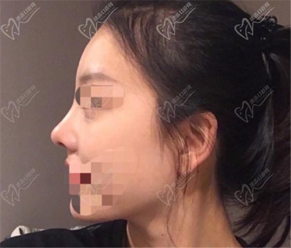 李信锋做鼻子怎么样