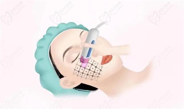 热玛吉