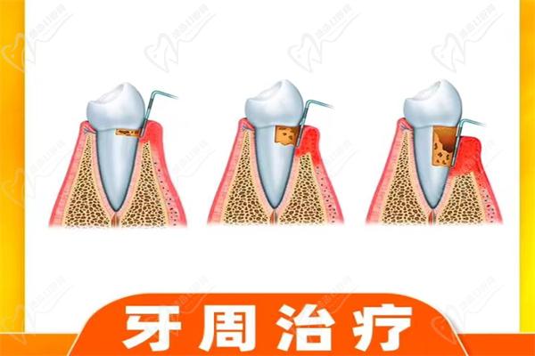 福州美橙口腔牙周治疗
